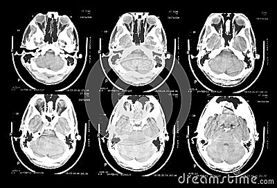 Ct scan brain
