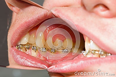 Dental braces on teeth - orthodontic treatment