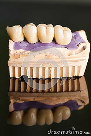 Dental bridge made of porcelain on casting