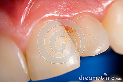 Dental cavity