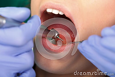 Dental drilling