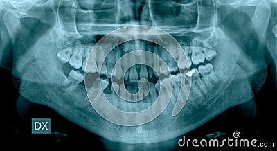 Dental X-Ray