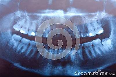 Dental x-ray