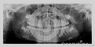 Dental X-Ray