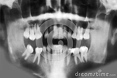 Dental X-Ray - Full Mouth Scan