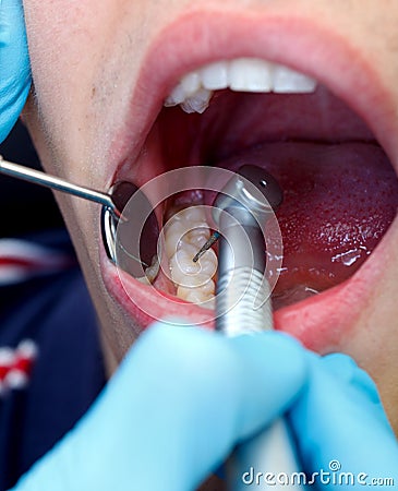 Dental drilling