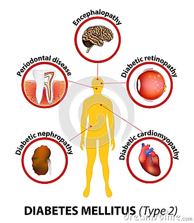 Diabetes Mellitus Type 2 Complications