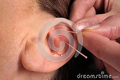 Ear acupuncture