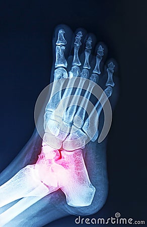 Film x-ray foot