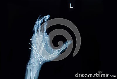 Film x-ray of hand fracture : show fracture metacarpal bone inse