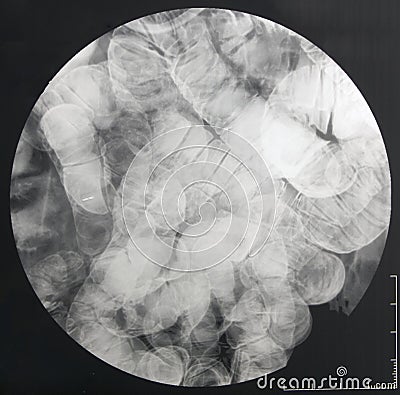 Fluoroscopic X-ray of the small intestine