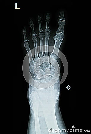 Foot x-rays image