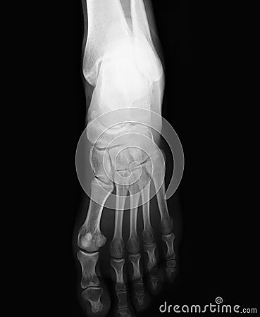 Foot xray