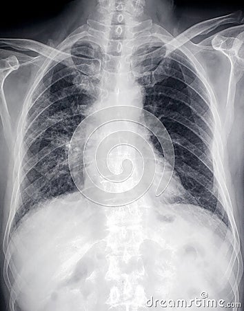Lung disease：front X-ray image of heart and ches