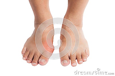 Gout Inflammation On The Right Foot Stock Photo Image 45652012