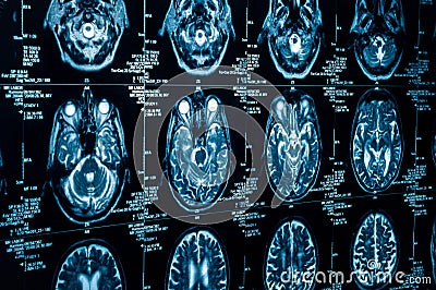 A group of CAT scans of the human brain