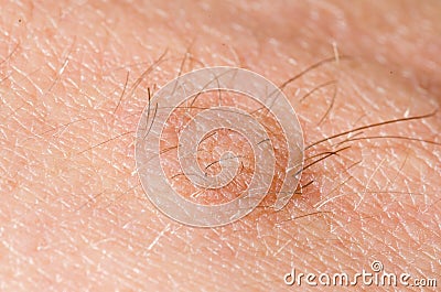 Hairy skin tag mole