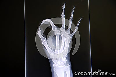 Hand X Ray