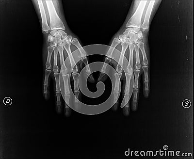 Hands under X-ray