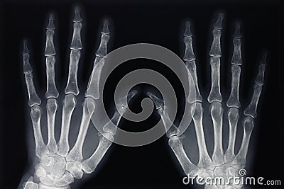 Hands X-ray