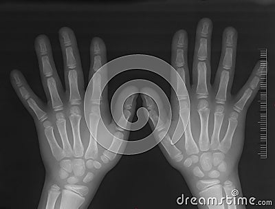 Hands x-ray