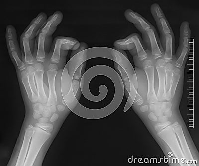 Hands x-ray