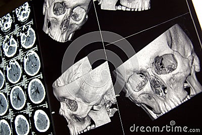 Traumatic brain injury, head bones and brain, CT
