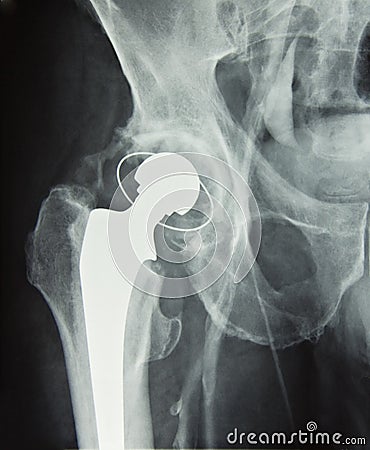 Hip prosthesis implant, hip replacement