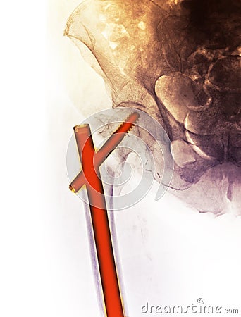 Hip x-ray showing a fracture