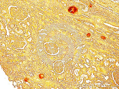 Histology slide of an abnormal Human Kidney