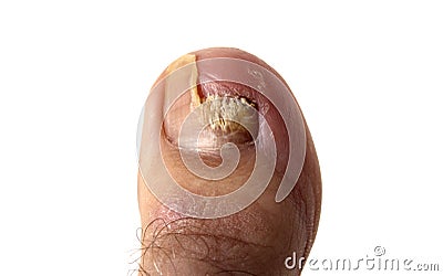 Los hongos en los pies como curar la medicina pública