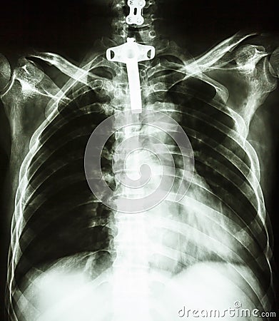 Human chest with tracheotomy tube