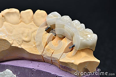 Implanted bridge teeth