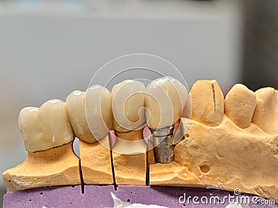 Implanted porcelain teeth