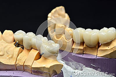 Teeth models with bridge implants