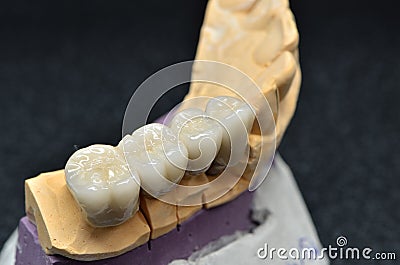 Teeth and porcelain crown