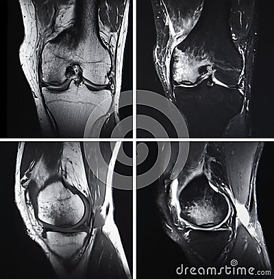 Injured knee, MRI