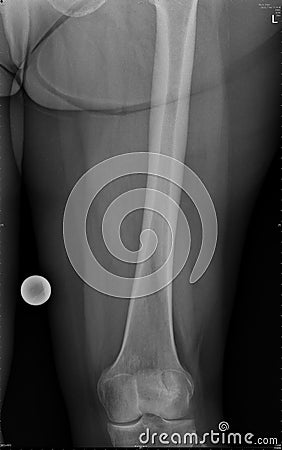 Knee joint and femur bone
