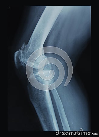 Knee x-ray