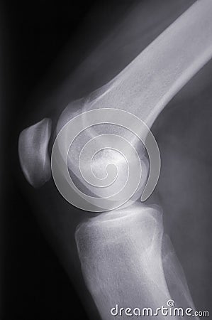 Knee X-ray