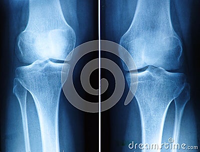 Knee x-ray