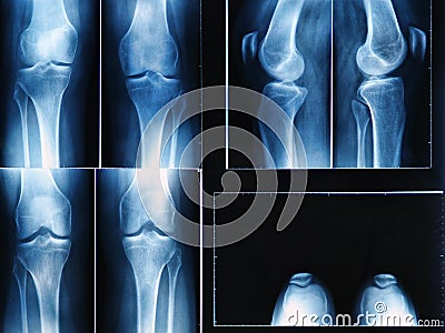 Knee x-ray