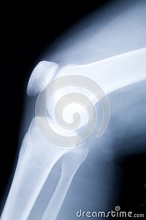 Knee x-ray image