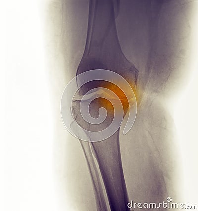 Knee X-ray, severe degenerative osteoarthritis