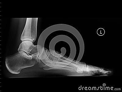 Left foot X-Ray