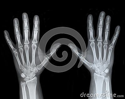 Left and Right Hand X-Ray