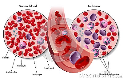 Leukemia FAQ: What causes leukemia? | RxWiki