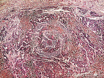 Liver cancer of a human