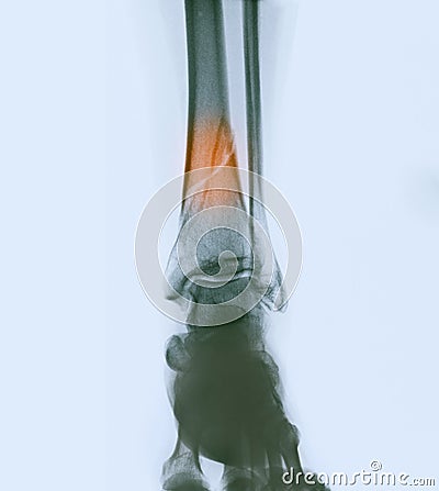 Lower leg x-ray showing a fracture