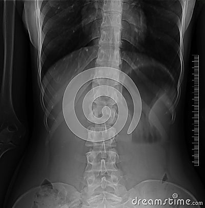 Lumbar spine x-ray